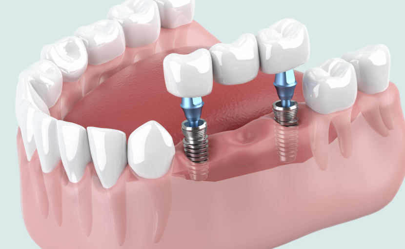 インプラント治療